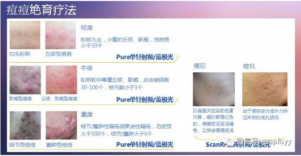 暑期“戰(zhàn)痘”鉅惠來襲，千萬別錯(cuò)過！內(nèi)附治療前后對比圖哦！7.jpg